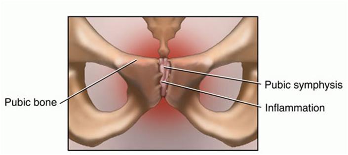 Osteitis Pubis Archview Physiotherapy Massage Dry Needling Pilates