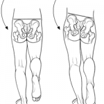 picture of functional glute medius and dysfunctional glute medius causing hip drop