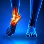 Arthritic Ankle Joint