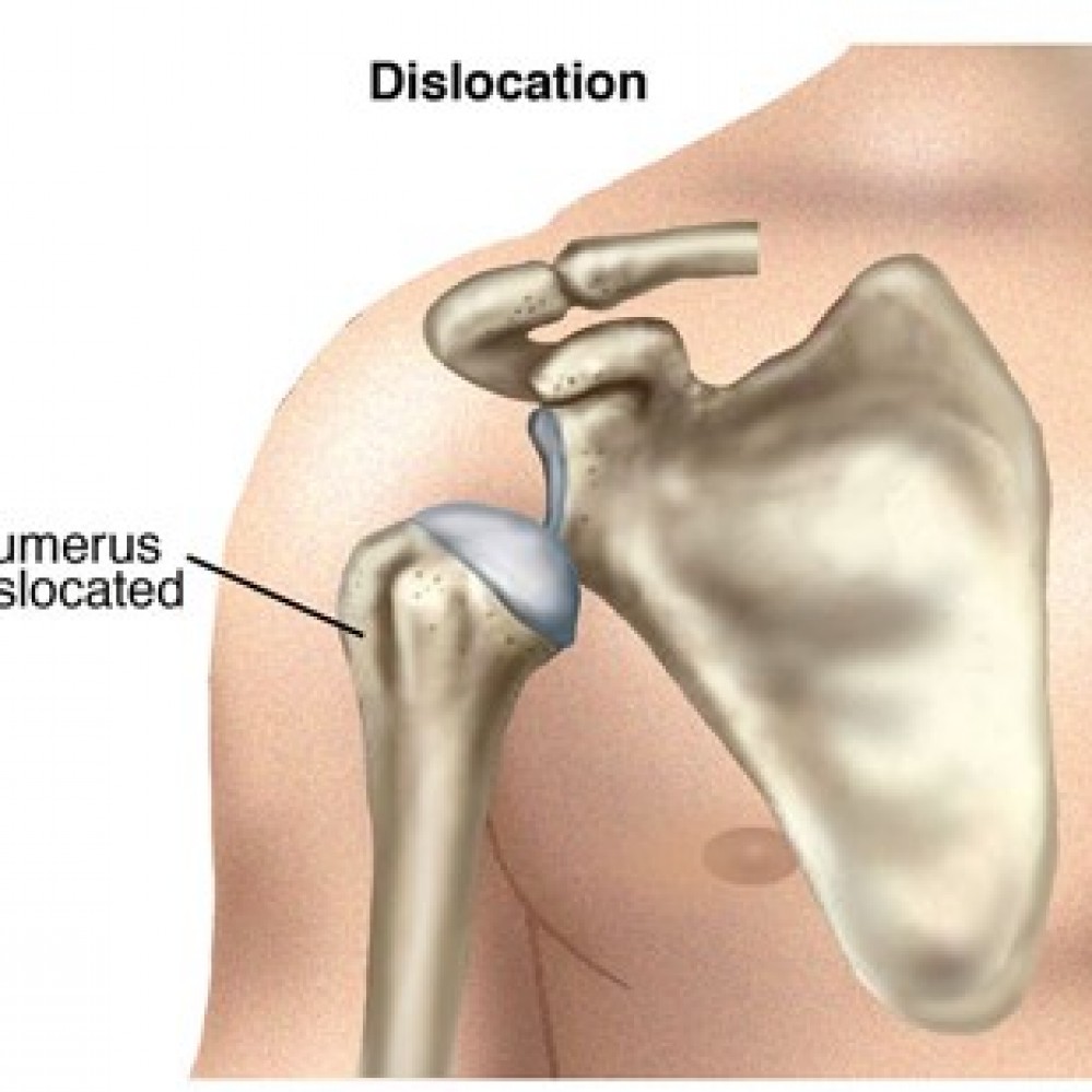 Archview Physiotherapy Clinic | Physiotherapist | Dislocated shoulder ...