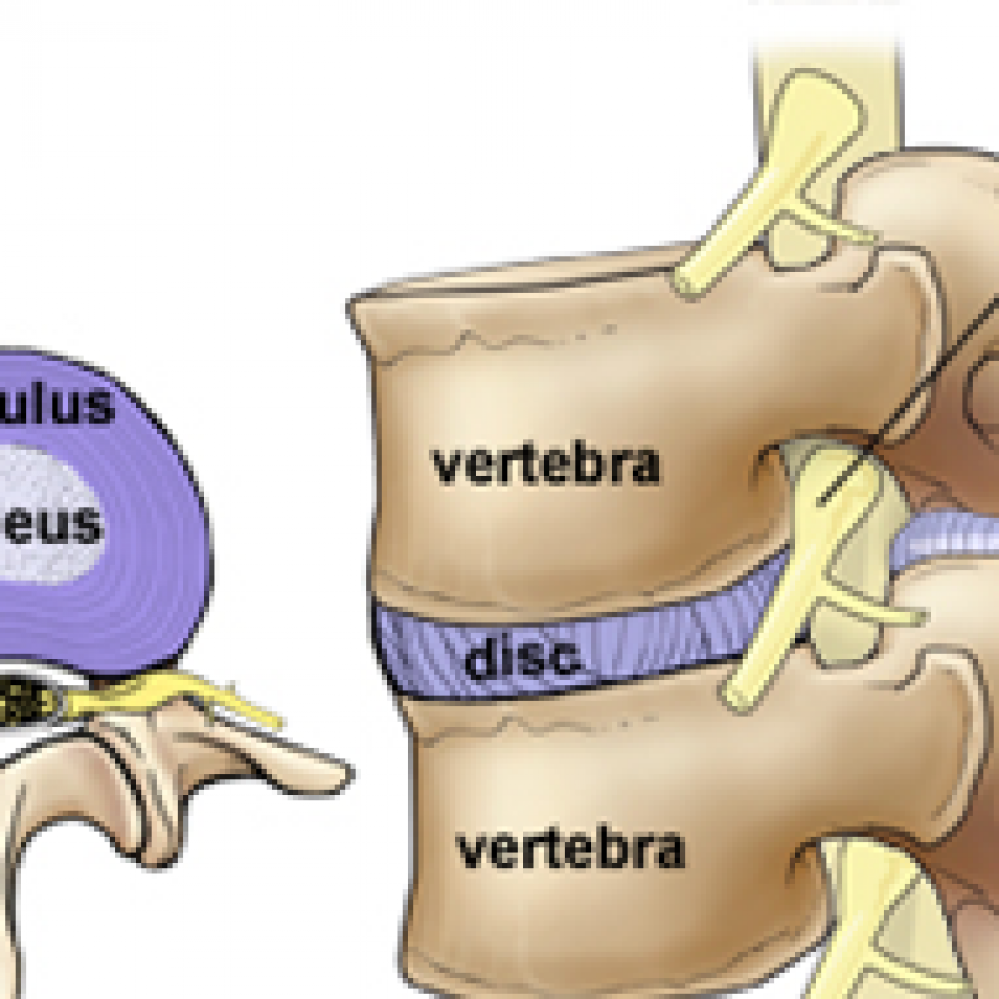 Disc Issues And Back Pain 