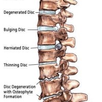 Image of the spine with a number of disc issues