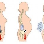 low back pain pregnancy
