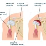Frozen shoulder anatomy
